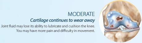 Moderate Knee