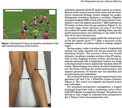 Distal Avulsion of the Semitendinosus Tendon